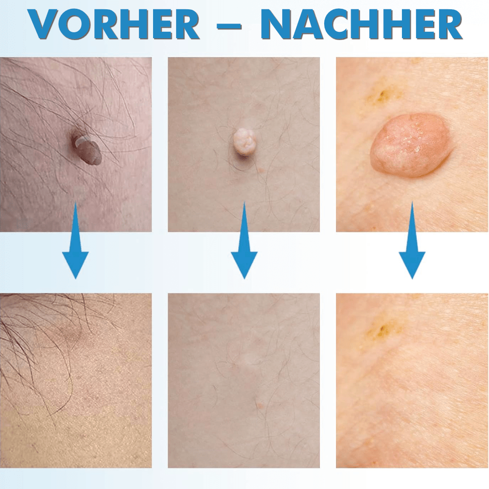 WarzenFrei - Der Stielwarzen Entferner
